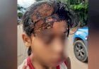 Em Goiás: Menina de 9 anos leva pedrada na cabeça durante briga por chocolate