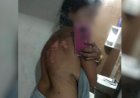 Em Goiás: Mulher tem corpo queimado com óleo quente após briga por ciúmes