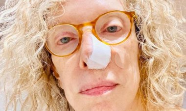 Câncer de pele de Marília Gabriela é traiçoeiro, mas não costuma alastrar