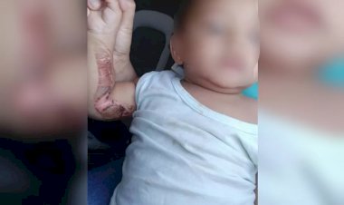 Em Goiás: Bebê com queimadura grave por carvão de narguilé é resgatado pelo Conselho Tutelar, e pais foram detidos e liberados, diz PM