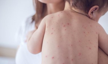Eclipsado pela Covid, sarampo se alastra e provoca duas mortes de bebês