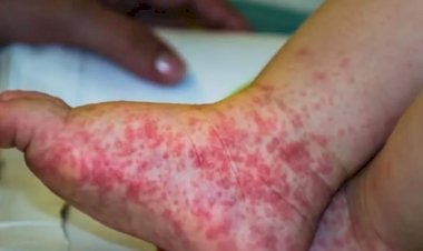 Saiba os sintomas da doença mão-pé-boca, que está causando surto em cidades do Brasil