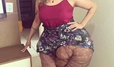Jovem faz cirurgia inedita no Brasil e remove 30kg de tumor