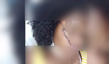 Menina leva golpe de facão no rosto ao defender amiga de agressão do namorado em Trindade