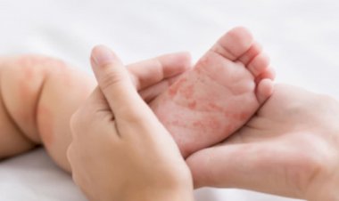 Goiás descarta casos suspeitos de sarampo em crianças
