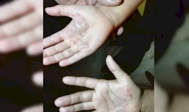 Em Goiás: Mãe é suspeita de queimar as mãos das filhas como castigo após as crianças comerem uma lata de leite condensado