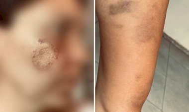 Mulher denuncia que ela e a companheira foram agredidas por vizinhos com socos, chutes e mordida por serem lésbicas