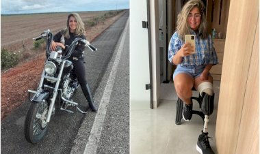 Mulher denuncia que teve parte da perna e dedos amputados após infecção generalizada causada por lipoaspiração
