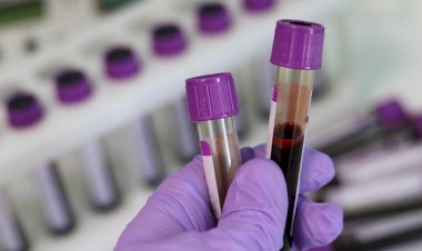 Cientistas desenvolvem exame de sangue inovador para identificar esquizofrenia
