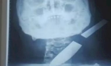 Mulher que teve faca cravada no pescoço pelo ex passa por cirurgia e está estável