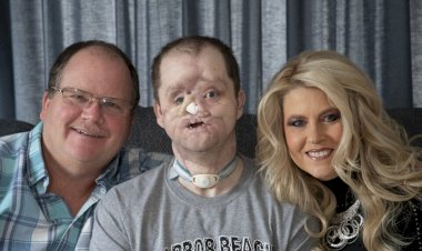 Homem recebe transplante de rosto inovador; veja antes e depois