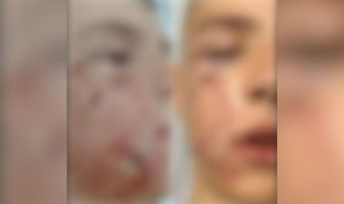 Menino de 10 anos é atacado por pit bull e precisa passar por cirurgia