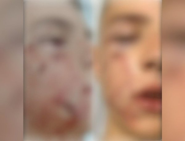 Menino de 10 anos é atacado por pit bull e precisa passar por cirurgia