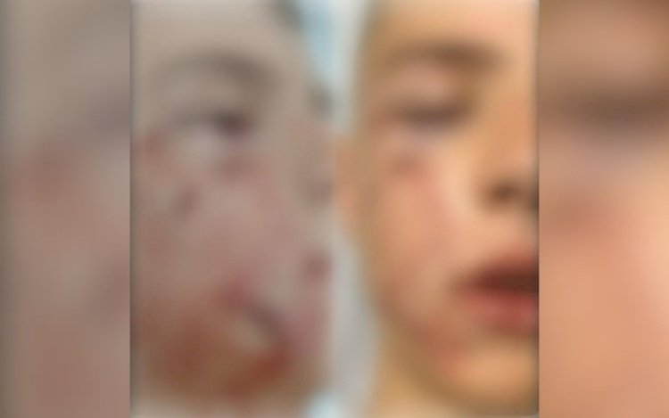 Menino de 10 anos é atacado por pit bull e precisa passar por cirurgia